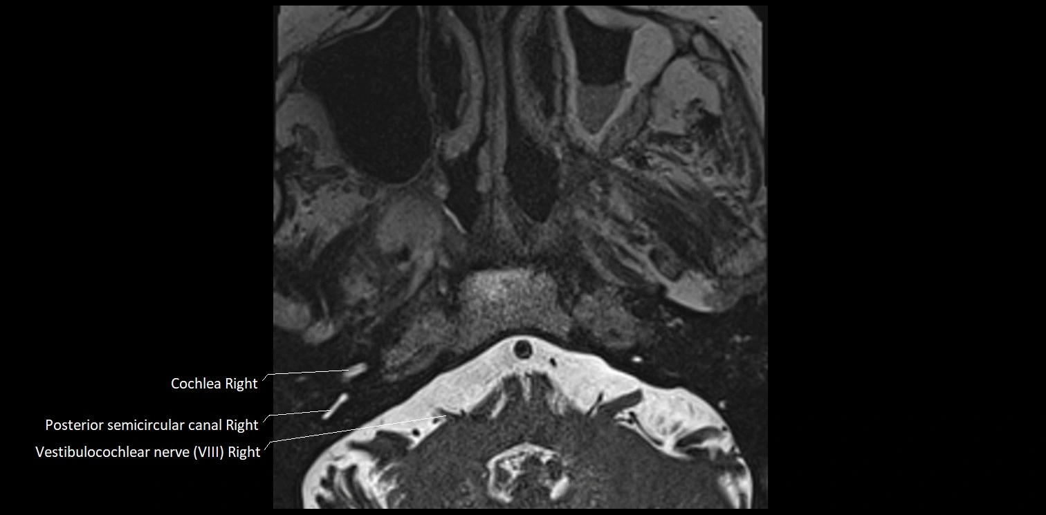 Cranial nerve anatomy axial MRI 3T image 63.webp